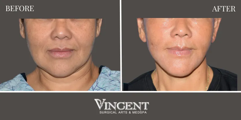 Facelift 3-1