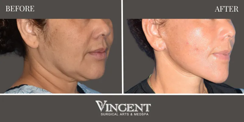 Facelift 3-2