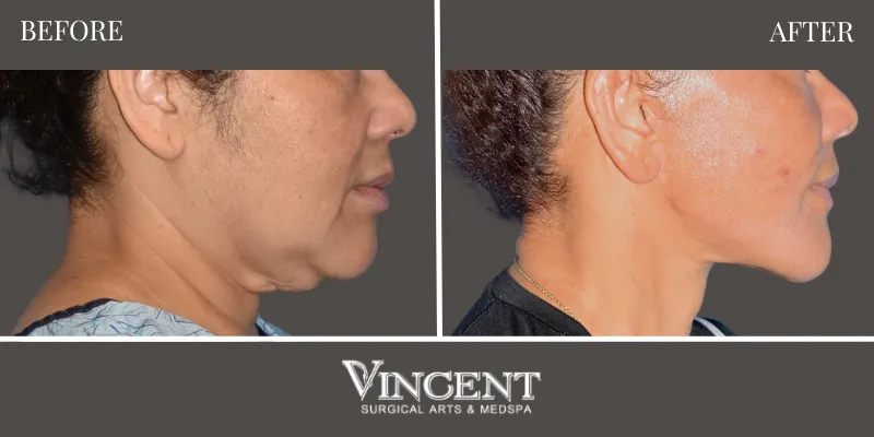 Facelift 3-3