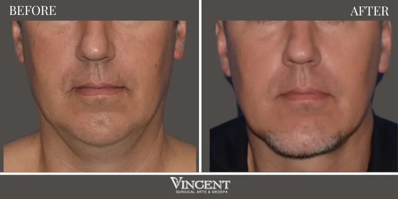 Facelift 6-1
