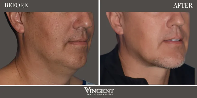 Facelift 6-2