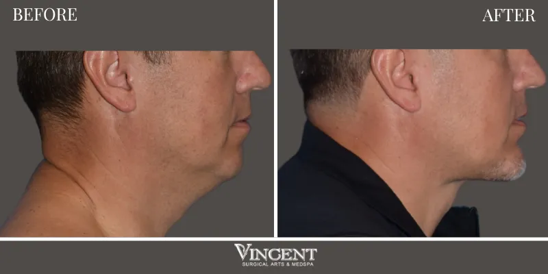 Facelift 6-3